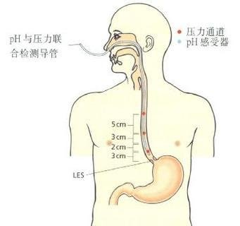消化道动力检测怎么做反复胃肠不适找不到原因？来南安这家医院试试消化道动力检测_https://www.jmylbn.com_新闻资讯_第6张