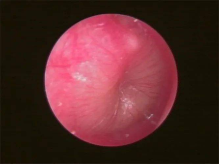 鼓膜治疗仪有什么用省直中医院耳鼻喉科新添置鼓膜治疗仪——治疗耳鸣、耳聋的“听诊器”_https://www.jmylbn.com_新闻资讯_第2张