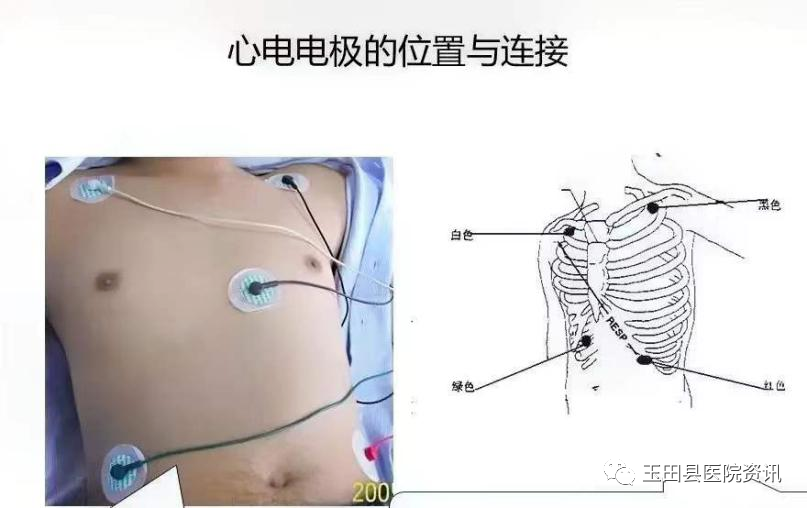 心电监测仪怎么看【科普专栏】心电监护仪的使用小知识（二）_https://www.jmylbn.com_新闻资讯_第3张