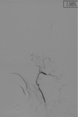 波科支架怎么样径技-弓上病例大赏｜第210期·右侧颈内动脉球囊扩张术+支架植入术_https://www.jmylbn.com_新闻资讯_第16张