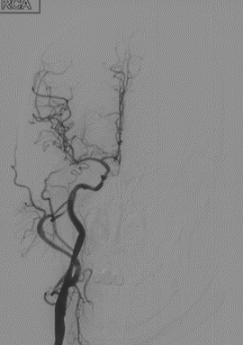 波科支架怎么样径技-弓上病例大赏｜第210期·右侧颈内动脉球囊扩张术+支架植入术_https://www.jmylbn.com_新闻资讯_第25张
