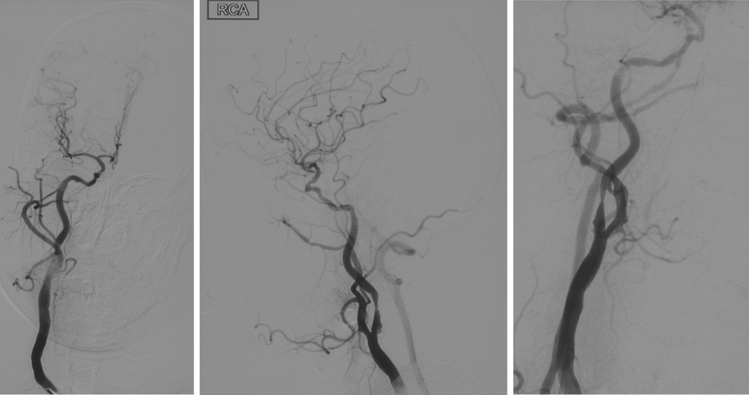 波科支架怎么样径技-弓上病例大赏｜第210期·右侧颈内动脉球囊扩张术+支架植入术_https://www.jmylbn.com_新闻资讯_第12张