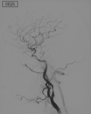 波科支架怎么样径技-弓上病例大赏｜第210期·右侧颈内动脉球囊扩张术+支架植入术_https://www.jmylbn.com_新闻资讯_第26张