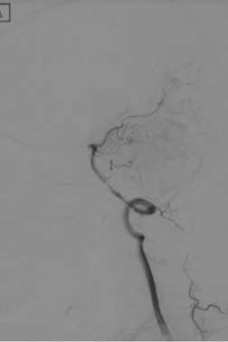 波科支架怎么样径技-弓上病例大赏｜第210期·右侧颈内动脉球囊扩张术+支架植入术_https://www.jmylbn.com_新闻资讯_第14张