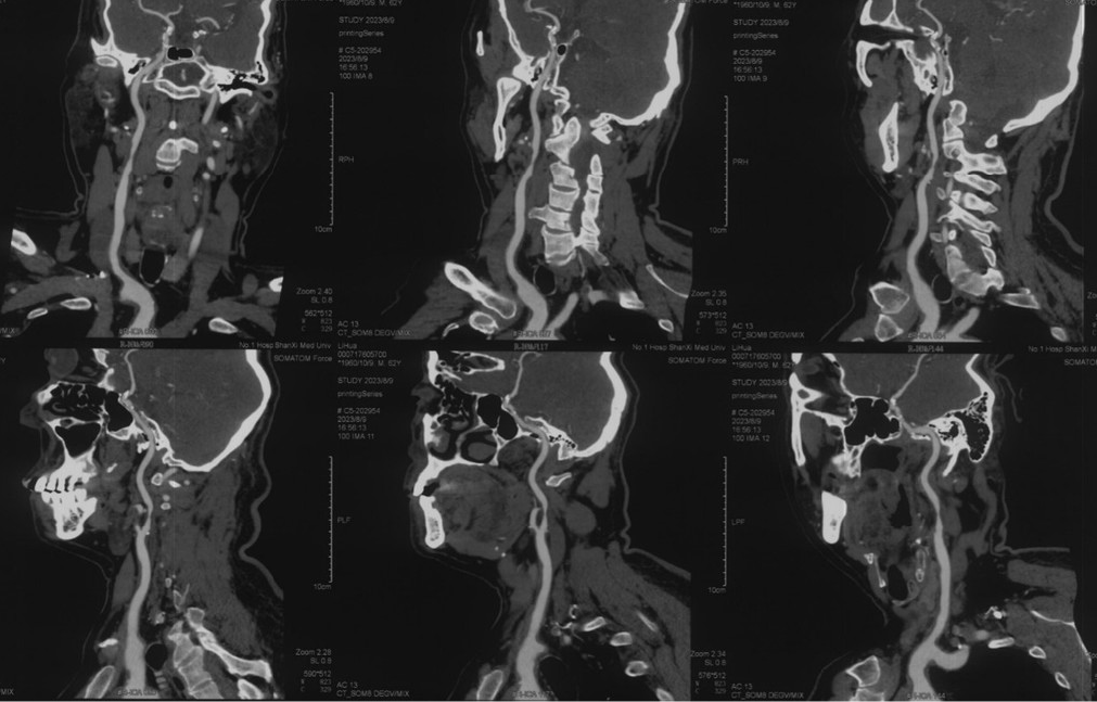 波科支架怎么样径技-弓上病例大赏｜第210期·右侧颈内动脉球囊扩张术+支架植入术_https://www.jmylbn.com_新闻资讯_第7张