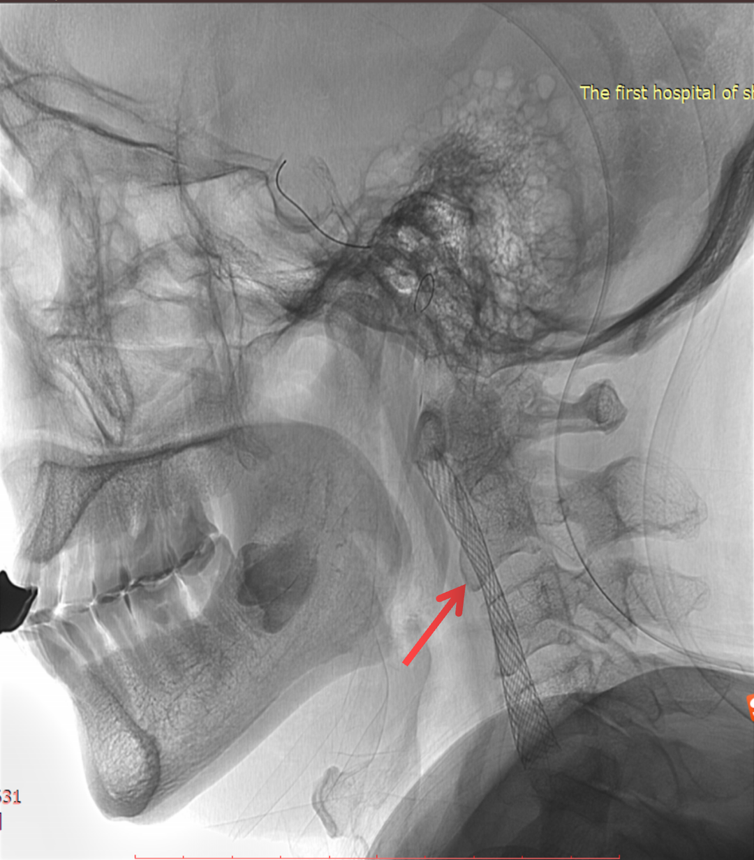 波科支架怎么样径技-弓上病例大赏｜第210期·右侧颈内动脉球囊扩张术+支架植入术_https://www.jmylbn.com_新闻资讯_第21张