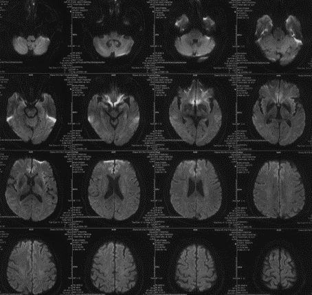 波科支架怎么样径技-弓上病例大赏｜第210期·右侧颈内动脉球囊扩张术+支架植入术_https://www.jmylbn.com_新闻资讯_第10张