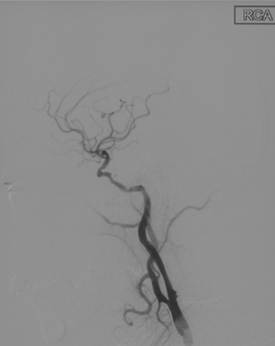 波科支架怎么样径技-弓上病例大赏｜第210期·右侧颈内动脉球囊扩张术+支架植入术_https://www.jmylbn.com_新闻资讯_第27张