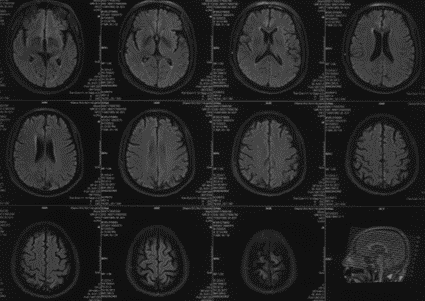 波科支架怎么样径技-弓上病例大赏｜第210期·右侧颈内动脉球囊扩张术+支架植入术_https://www.jmylbn.com_新闻资讯_第9张