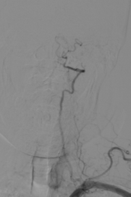 波科支架怎么样径技-弓上病例大赏｜第210期·右侧颈内动脉球囊扩张术+支架植入术_https://www.jmylbn.com_新闻资讯_第15张