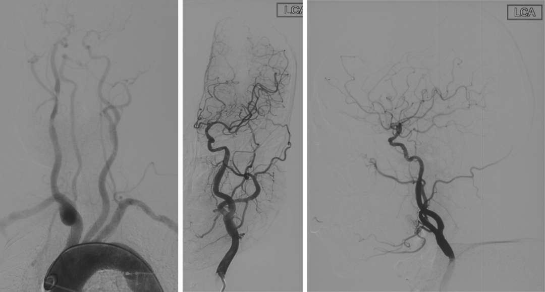 波科支架怎么样径技-弓上病例大赏｜第210期·右侧颈内动脉球囊扩张术+支架植入术_https://www.jmylbn.com_新闻资讯_第11张