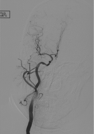 波科支架怎么样径技-弓上病例大赏｜第210期·右侧颈内动脉球囊扩张术+支架植入术_https://www.jmylbn.com_新闻资讯_第24张