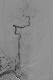 波科支架怎么样径技-弓上病例大赏｜第210期·右侧颈内动脉球囊扩张术+支架植入术_https://www.jmylbn.com_新闻资讯_第13张