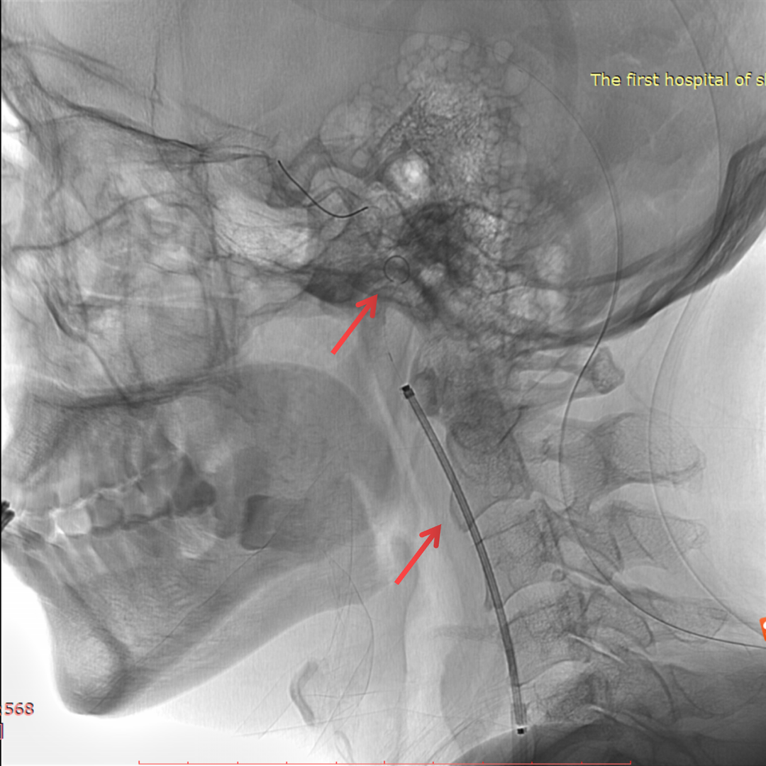 波科支架怎么样径技-弓上病例大赏｜第210期·右侧颈内动脉球囊扩张术+支架植入术_https://www.jmylbn.com_新闻资讯_第17张