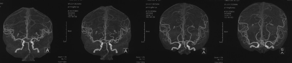 波科支架怎么样径技-弓上病例大赏｜第210期·右侧颈内动脉球囊扩张术+支架植入术_https://www.jmylbn.com_新闻资讯_第8张