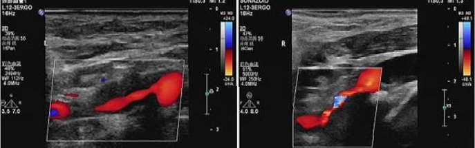 波科支架怎么样​径技·第165期｜7F经桡入路下的颈动脉狭窄支架成形术一例_https://www.jmylbn.com_新闻资讯_第6张