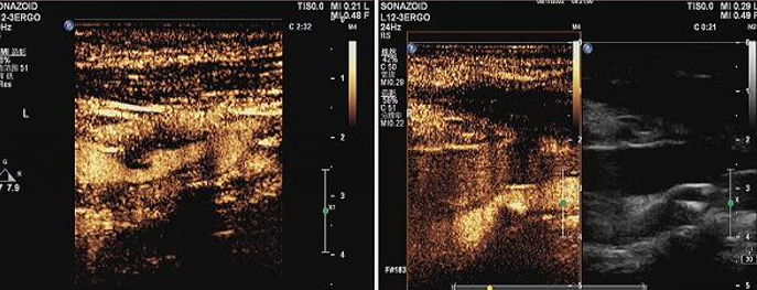 波科支架怎么样​径技·第165期｜7F经桡入路下的颈动脉狭窄支架成形术一例_https://www.jmylbn.com_新闻资讯_第7张