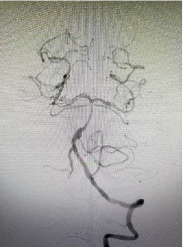 导管鞘怎么念有励可说｜Locaste长鞘及Skathi中间导管在基底动脉取栓术中的应用_https://www.jmylbn.com_新闻资讯_第22张