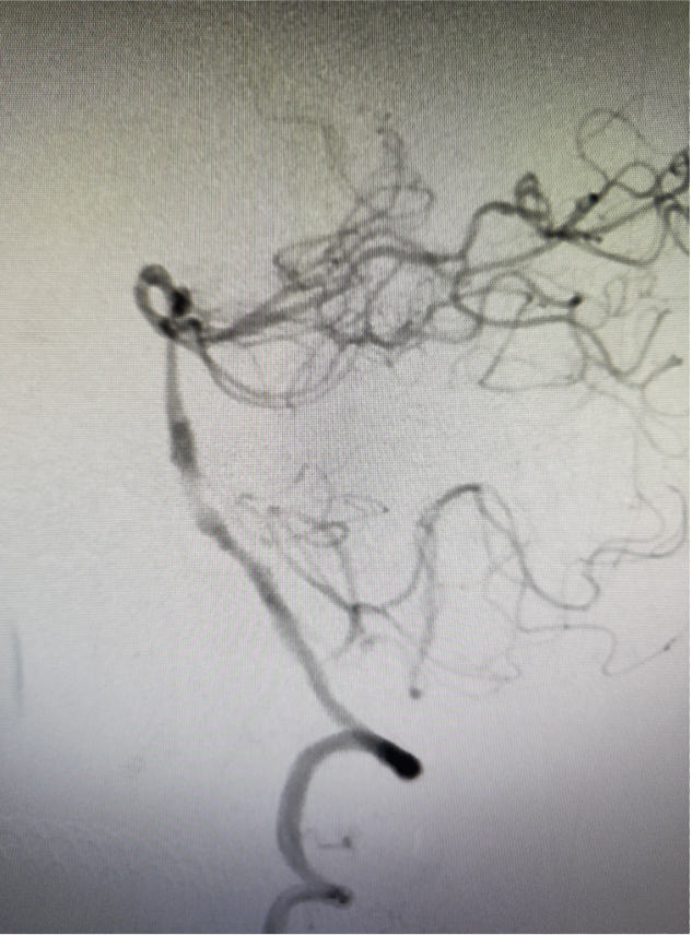 导管鞘怎么念有励可说｜Locaste长鞘及Skathi中间导管在基底动脉取栓术中的应用_https://www.jmylbn.com_新闻资讯_第23张