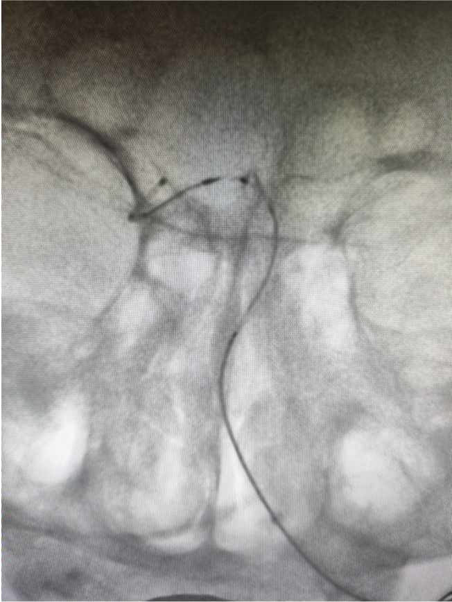 导管鞘怎么念有励可说｜Locaste长鞘及Skathi中间导管在基底动脉取栓术中的应用_https://www.jmylbn.com_新闻资讯_第21张