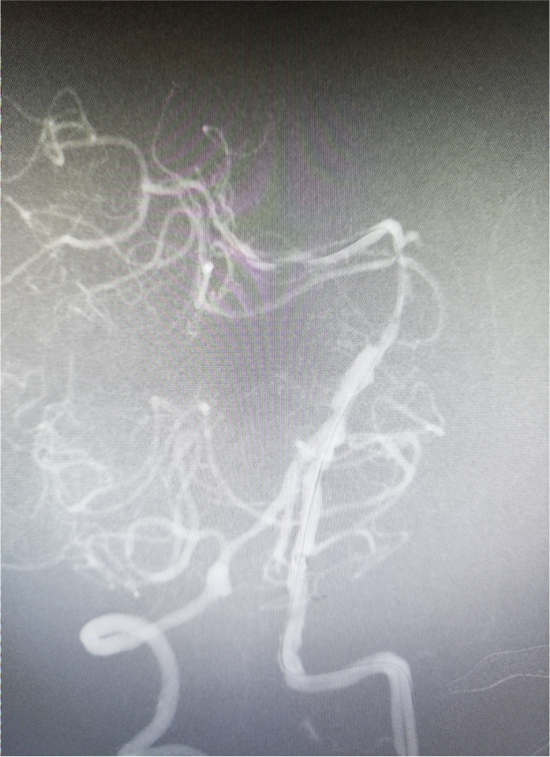 导管鞘怎么念有励可说｜Locaste长鞘及Skathi中间导管在基底动脉取栓术中的应用_https://www.jmylbn.com_新闻资讯_第20张