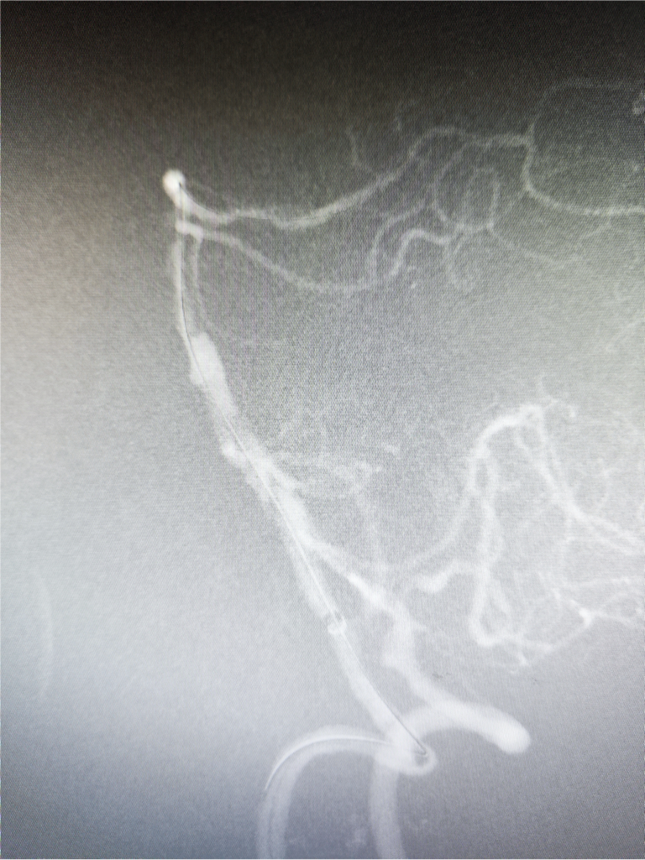 导管鞘怎么念有励可说｜Locaste长鞘及Skathi中间导管在基底动脉取栓术中的应用_https://www.jmylbn.com_新闻资讯_第19张