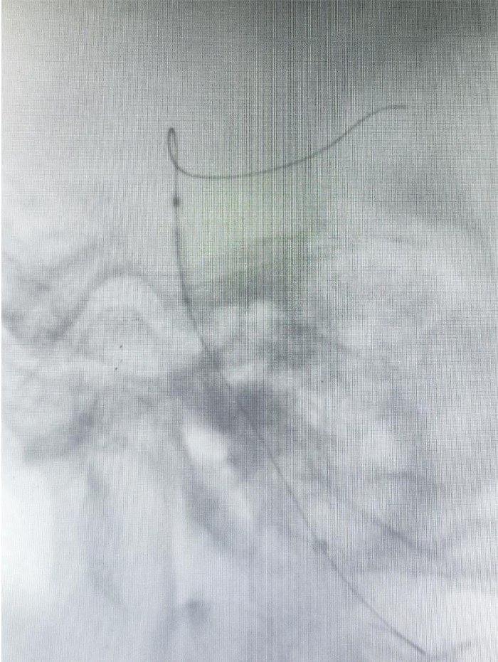导管鞘怎么念有励可说｜Locaste长鞘及Skathi中间导管在基底动脉取栓术中的应用_https://www.jmylbn.com_新闻资讯_第18张