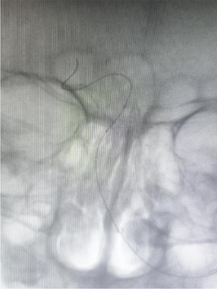 导管鞘怎么念有励可说｜Locaste长鞘及Skathi中间导管在基底动脉取栓术中的应用_https://www.jmylbn.com_新闻资讯_第17张