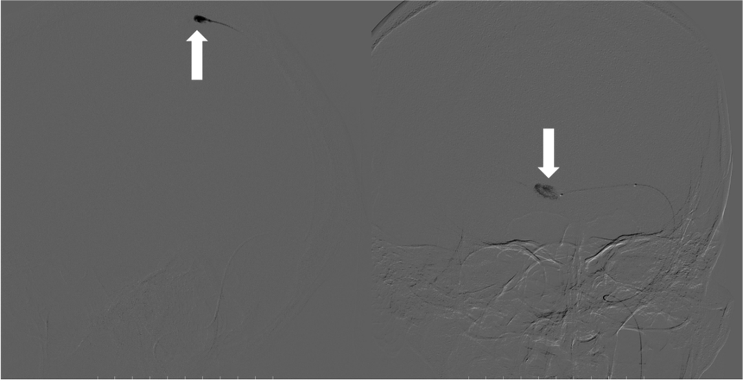血栓泵是什么健谈卒中｜ACE抽吸导管配合专用抽吸泵治疗颅内静脉窦高负荷量血栓一例_https://www.jmylbn.com_新闻资讯_第11张