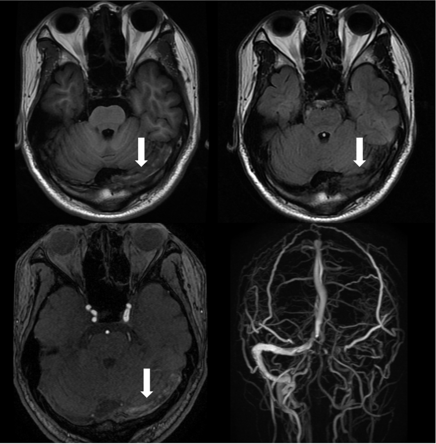 血栓泵是什么健谈卒中｜ACE抽吸导管配合专用抽吸泵治疗颅内静脉窦高负荷量血栓一例_https://www.jmylbn.com_新闻资讯_第5张