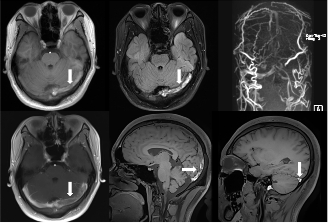 血栓泵是什么健谈卒中｜ACE抽吸导管配合专用抽吸泵治疗颅内静脉窦高负荷量血栓一例_https://www.jmylbn.com_新闻资讯_第6张