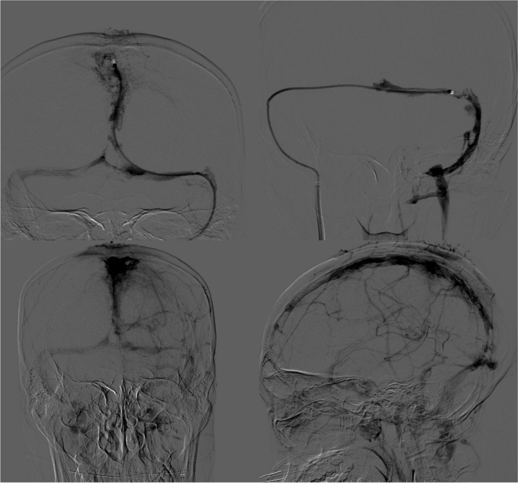血栓泵是什么健谈卒中｜ACE抽吸导管配合专用抽吸泵治疗颅内静脉窦高负荷量血栓一例_https://www.jmylbn.com_新闻资讯_第10张