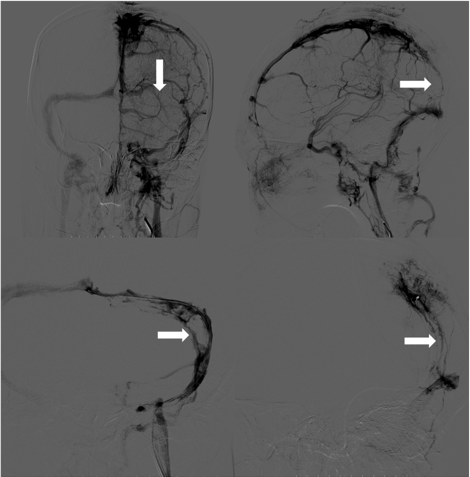 血栓泵是什么健谈卒中｜ACE抽吸导管配合专用抽吸泵治疗颅内静脉窦高负荷量血栓一例_https://www.jmylbn.com_新闻资讯_第7张