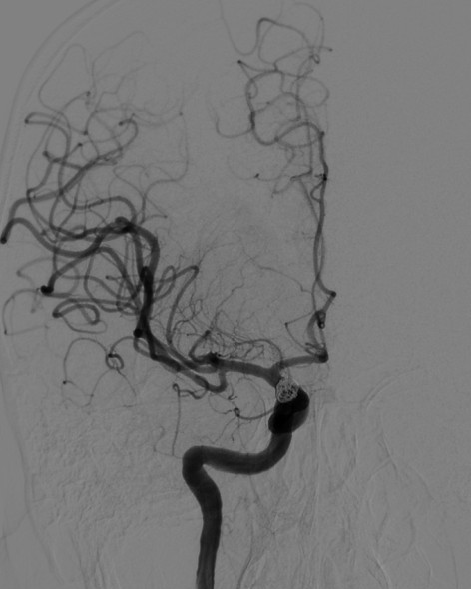 动脉长鞘怎么置入深谋远路 ｜ 千人皆翘首，万唤今始来——国内首款7F长鞘在血流导向密网支架联合弹簧圈栓塞治疗动脉瘤的首次应用_https://www.jmylbn.com_新闻资讯_第27张