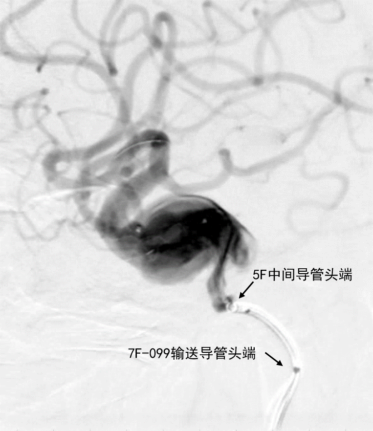 动脉长鞘怎么置入深谋远路 ｜ 千人皆翘首，万唤今始来——国内首款7F长鞘在血流导向密网支架联合弹簧圈栓塞治疗动脉瘤的首次应用_https://www.jmylbn.com_新闻资讯_第11张