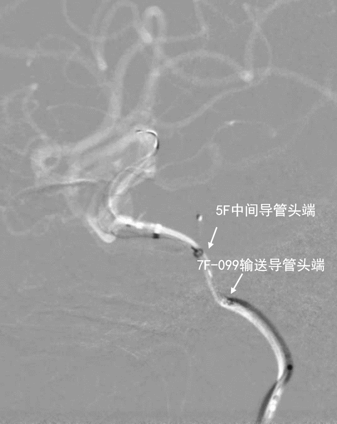 动脉长鞘怎么置入深谋远路 ｜ 千人皆翘首，万唤今始来——国内首款7F长鞘在血流导向密网支架联合弹簧圈栓塞治疗动脉瘤的首次应用_https://www.jmylbn.com_新闻资讯_第6张