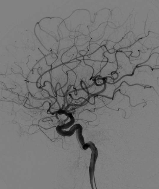 动脉长鞘怎么置入深谋远路 ｜ 千人皆翘首，万唤今始来——国内首款7F长鞘在血流导向密网支架联合弹簧圈栓塞治疗动脉瘤的首次应用_https://www.jmylbn.com_新闻资讯_第28张