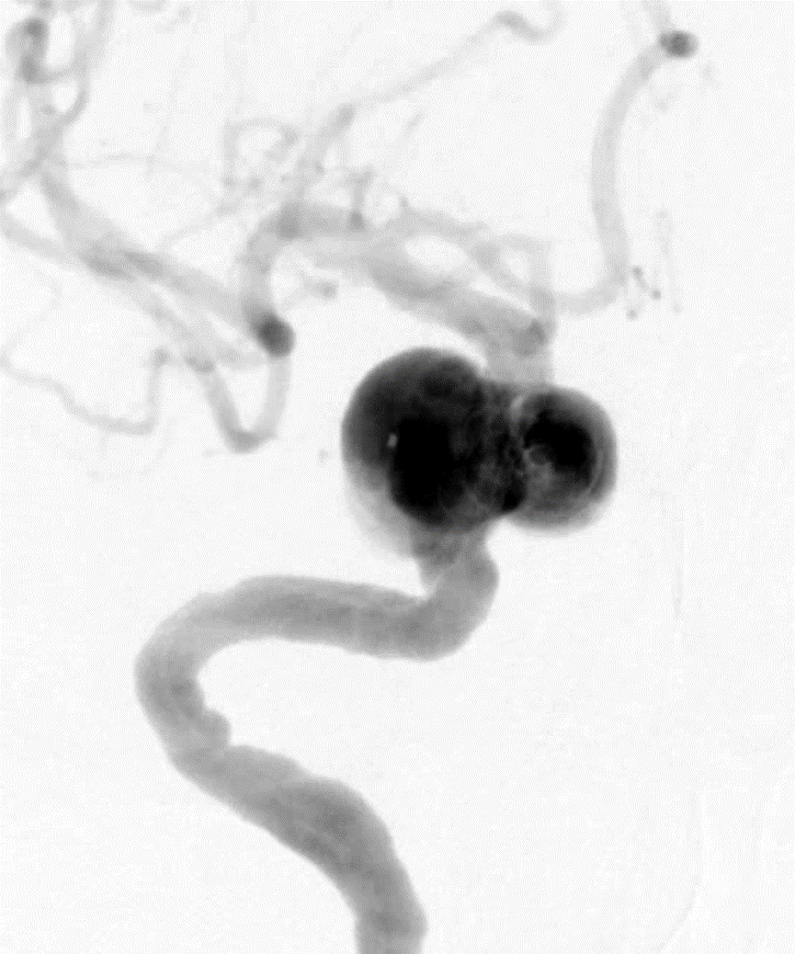 动脉长鞘怎么置入深谋远路 ｜ 千人皆翘首，万唤今始来——国内首款7F长鞘在血流导向密网支架联合弹簧圈栓塞治疗动脉瘤的首次应用_https://www.jmylbn.com_新闻资讯_第13张