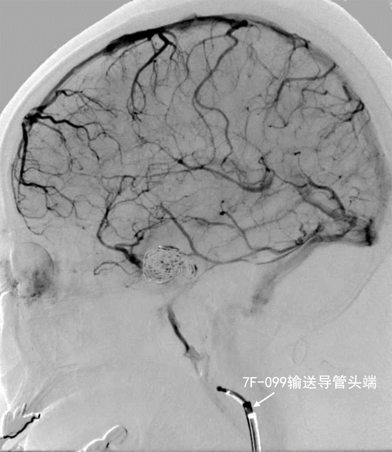 动脉长鞘怎么置入深谋远路 ｜ 千人皆翘首，万唤今始来——国内首款7F长鞘在血流导向密网支架联合弹簧圈栓塞治疗动脉瘤的首次应用_https://www.jmylbn.com_新闻资讯_第17张