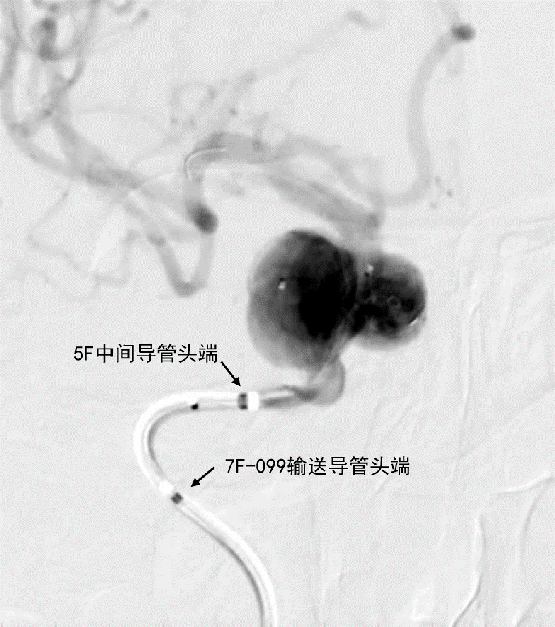 动脉长鞘怎么置入深谋远路 ｜ 千人皆翘首，万唤今始来——国内首款7F长鞘在血流导向密网支架联合弹簧圈栓塞治疗动脉瘤的首次应用_https://www.jmylbn.com_新闻资讯_第10张