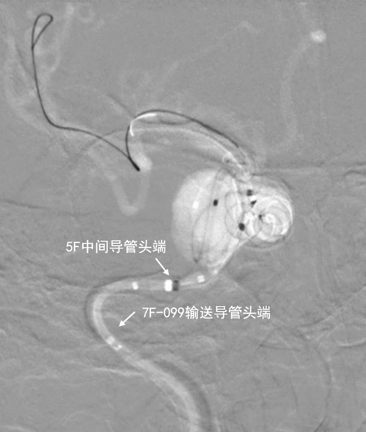 动脉长鞘怎么置入深谋远路 ｜ 千人皆翘首，万唤今始来——国内首款7F长鞘在血流导向密网支架联合弹簧圈栓塞治疗动脉瘤的首次应用_https://www.jmylbn.com_新闻资讯_第7张