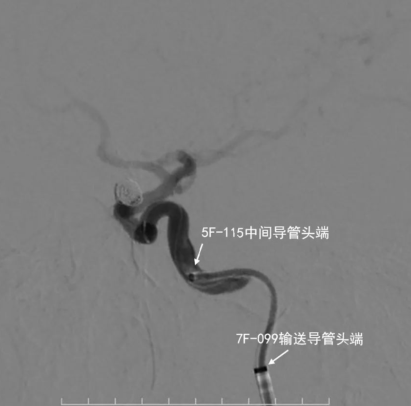 动脉长鞘怎么置入深谋远路 ｜ 千人皆翘首，万唤今始来——国内首款7F长鞘在血流导向密网支架联合弹簧圈栓塞治疗动脉瘤的首次应用_https://www.jmylbn.com_新闻资讯_第29张
