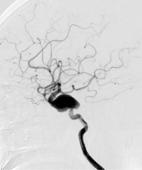 动脉长鞘怎么置入深谋远路 ｜ 千人皆翘首，万唤今始来——国内首款7F长鞘在血流导向密网支架联合弹簧圈栓塞治疗动脉瘤的首次应用_https://www.jmylbn.com_新闻资讯_第5张