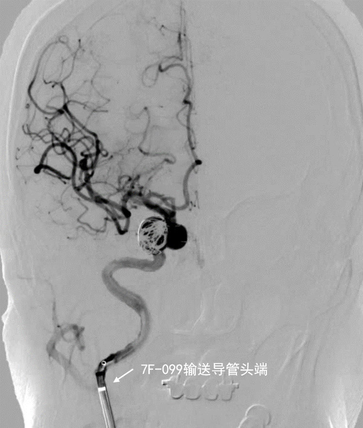 动脉长鞘怎么置入深谋远路 ｜ 千人皆翘首，万唤今始来——国内首款7F长鞘在血流导向密网支架联合弹簧圈栓塞治疗动脉瘤的首次应用_https://www.jmylbn.com_新闻资讯_第16张