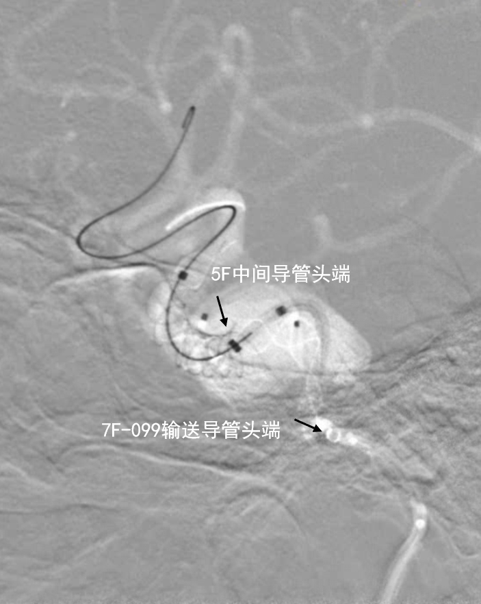 动脉长鞘怎么置入深谋远路 ｜ 千人皆翘首，万唤今始来——国内首款7F长鞘在血流导向密网支架联合弹簧圈栓塞治疗动脉瘤的首次应用_https://www.jmylbn.com_新闻资讯_第9张