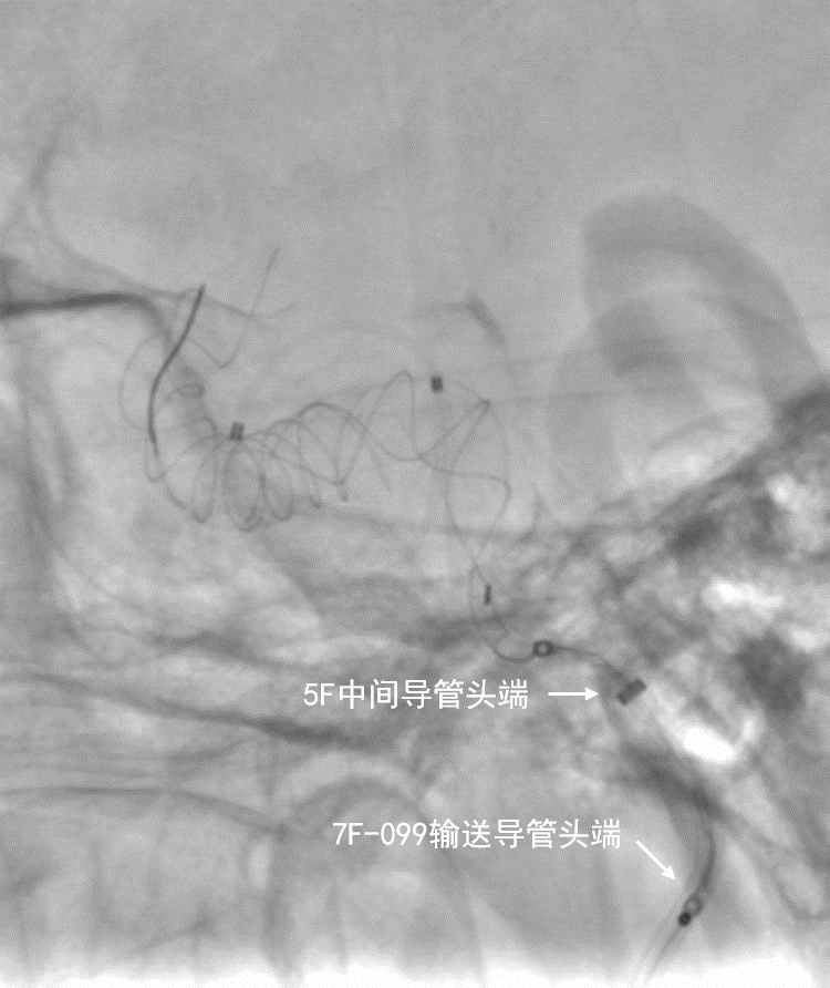 动脉长鞘怎么置入深谋远路 ｜ 千人皆翘首，万唤今始来——国内首款7F长鞘在血流导向密网支架联合弹簧圈栓塞治疗动脉瘤的首次应用_https://www.jmylbn.com_新闻资讯_第12张