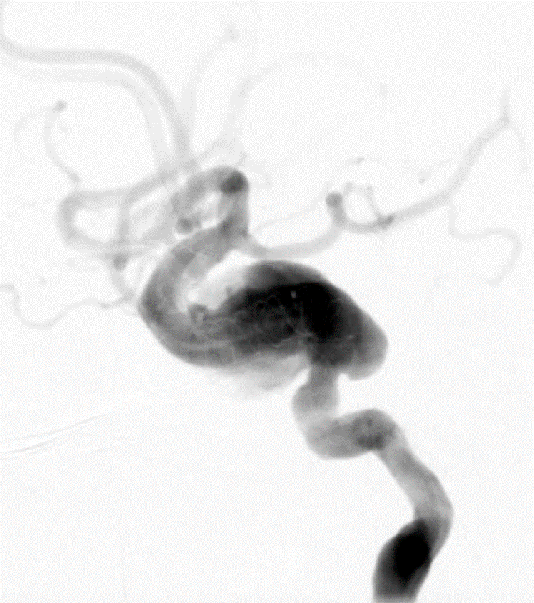 动脉长鞘怎么置入深谋远路 ｜ 千人皆翘首，万唤今始来——国内首款7F长鞘在血流导向密网支架联合弹簧圈栓塞治疗动脉瘤的首次应用_https://www.jmylbn.com_新闻资讯_第14张