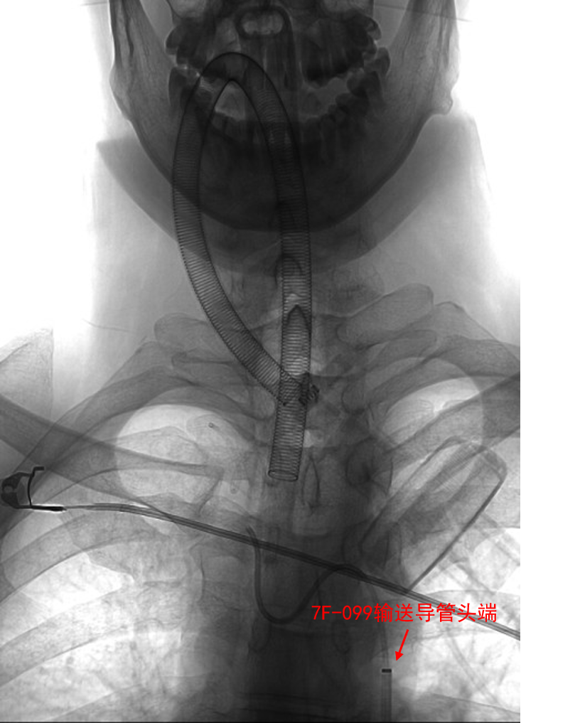动脉长鞘怎么置入深谋远路 ｜ 千人皆翘首，万唤今始来——国内首款7F长鞘在血流导向密网支架联合弹簧圈栓塞治疗动脉瘤的首次应用_https://www.jmylbn.com_新闻资讯_第24张
