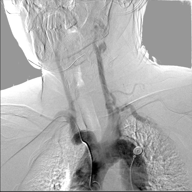 动脉长鞘怎么置入【康德莱医械】经桡介入LA长鞘+Sim II通路组合处理颈内动脉狭窄_https://www.jmylbn.com_新闻资讯_第7张