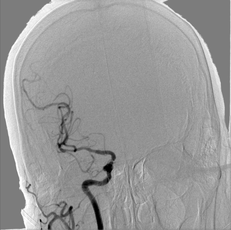 动脉长鞘怎么置入【康德莱医械】经桡介入LA长鞘+Sim II通路组合处理颈内动脉狭窄_https://www.jmylbn.com_新闻资讯_第11张